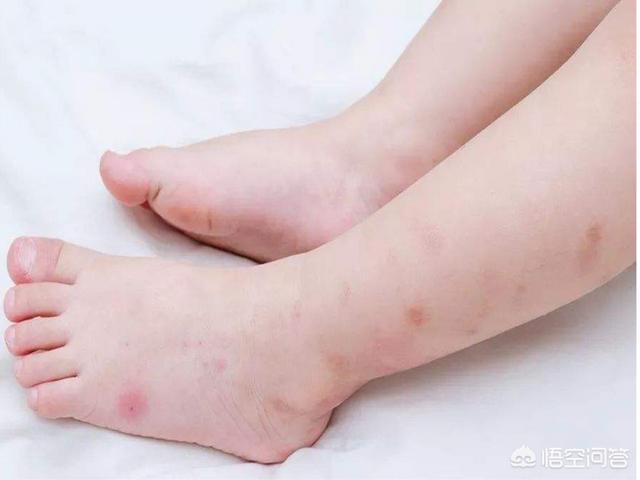 木瓜膏可以去疤痕吗，请教如何去除宝宝身上蚊虫叮咬疤痕