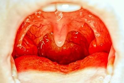 头条问答 扁桃体炎会传染吗 症状有哪些 7个回答