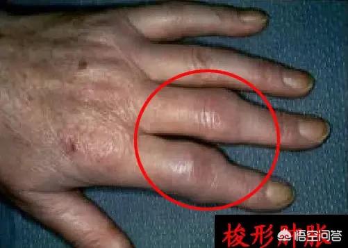 膝盖关节炎症状:怀疑膝关节炎如何自我检查？