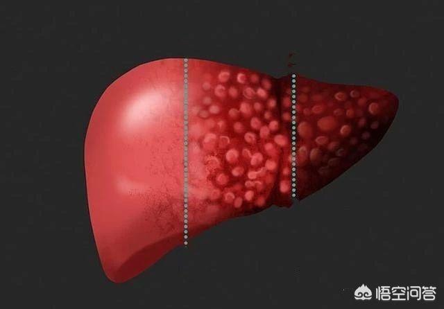 大腿肚内侧黑紫图:有人说患上肝癌，会有“三处变色，两处变臭”，指的是哪？