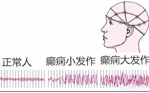 失神小发作图片