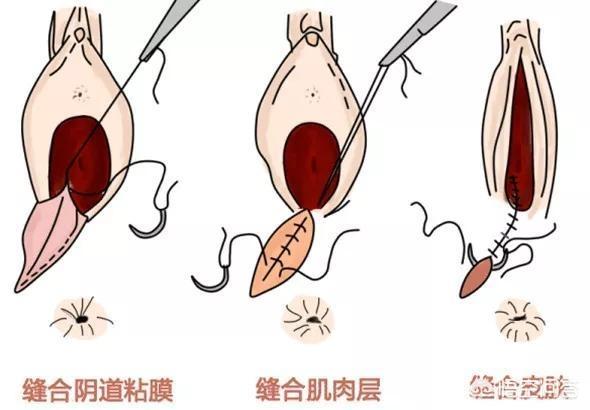 头条问答 - 什么是侧切?(2个回答)
