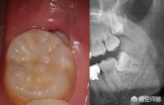拔智齿真的可以瘦脸吗有何依据