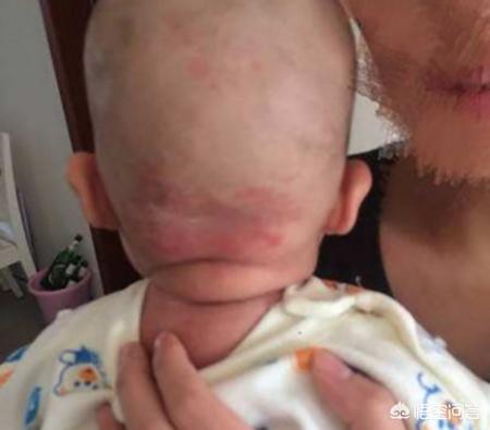 新生儿毒性红斑，新生儿脸上起了小红疙瘩怎么回事