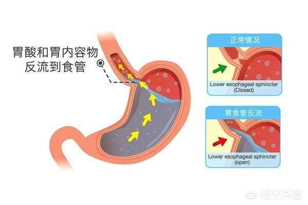 有哪些治疗反流性食管炎的方法