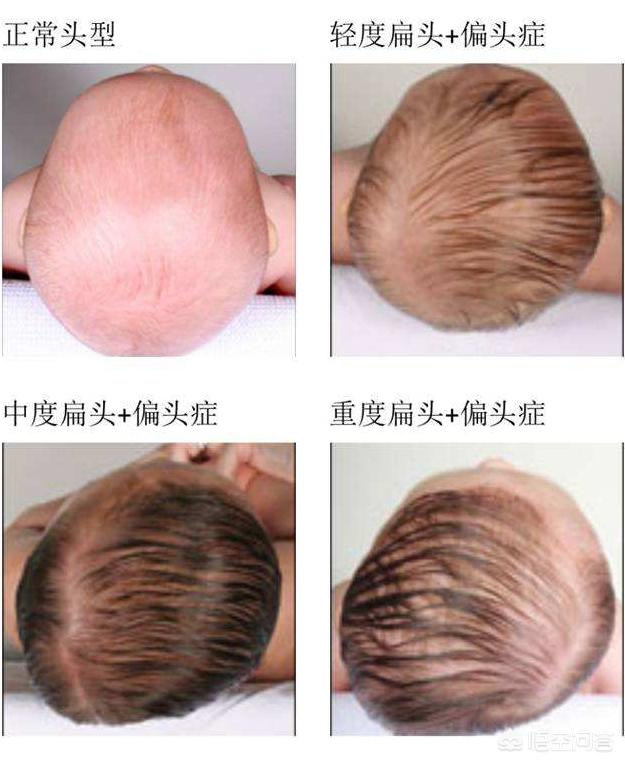 宝宝的头多久就定型了，新生儿2个月偏头多久可以纠正过来？