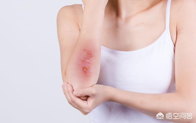 手术后注意事项:手术后护理有没有什么特别需要注意的？