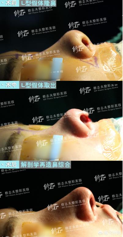 割鼻子:隆鼻手术对整个人面部的改变大吗？