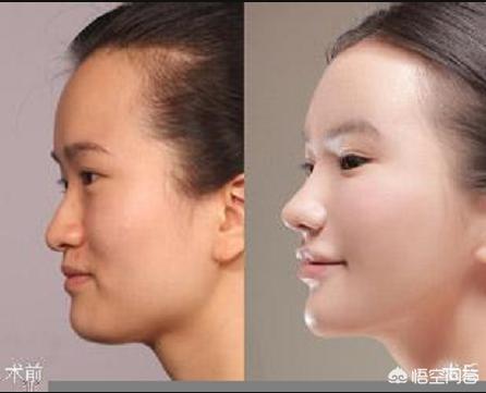 人鼻腔结构图:鼻子的结构是什么样子的？
