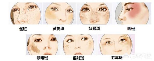 如何祛斑效果好(快速有效祛斑方法)