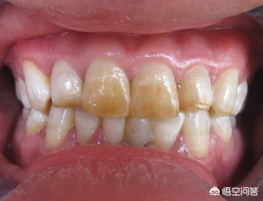 谁知道四环素牙怎么治:牙齿发黄，刷牙也解决不了，怎么办？