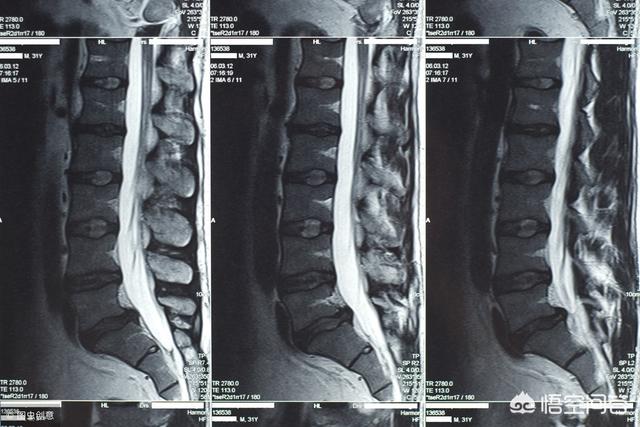 常见脊柱病:常见脊柱病变表现有哪些 脊柱侧弯该如何治疗？需要注意哪些问题？