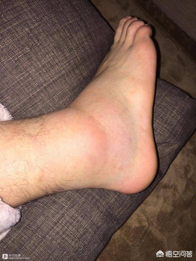 头条问答 - 打球崴脚怎么办?(15个回答)