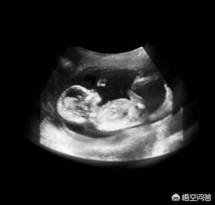 什么时候可以感受到胎动，现在怀孕15周了，可以感受到胎动了吗