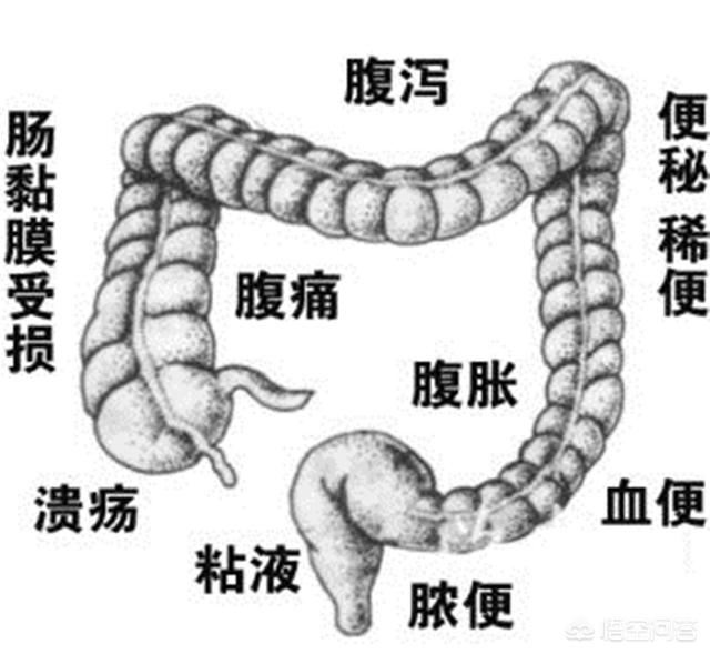 急性肠炎的症状:急性肠炎的症状表现有哪些 慢性肠炎和急性肠炎有什么区别？