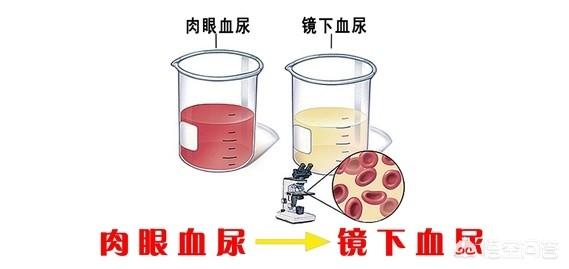 女性血尿血便是什么原因引起的:血尿都是如何引起的？发现血尿以后该如何办才是正确的？