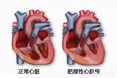 肥厚性心肌病:肥厚性心肌病吃什么药 肥厚性梗阻性心肌病该怎么治疗？