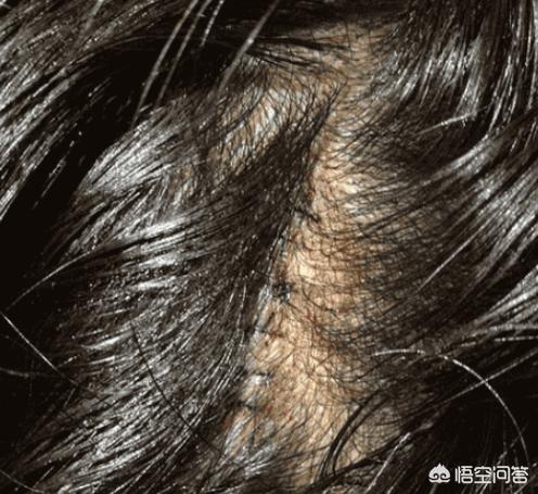 如何知道自己头皮有没有螨虫，怎么判断自己毛孔里有没有“大螨虫”，避免毛孔粗大等问题？