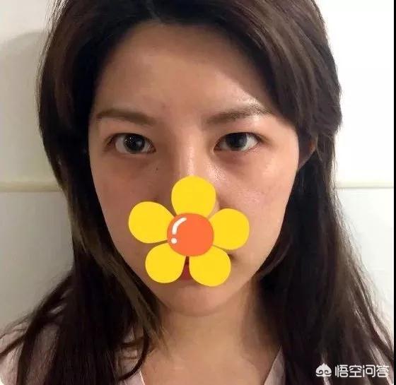 郑柔美整容前后:最早一批做双眼皮手术的人怎么样了？