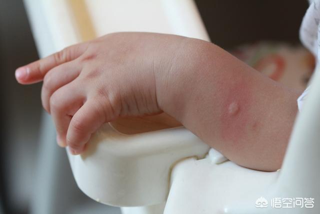 被什么虫子咬了会起一串红包:4岁宝宝得了虫咬皮炎应该怎么办？