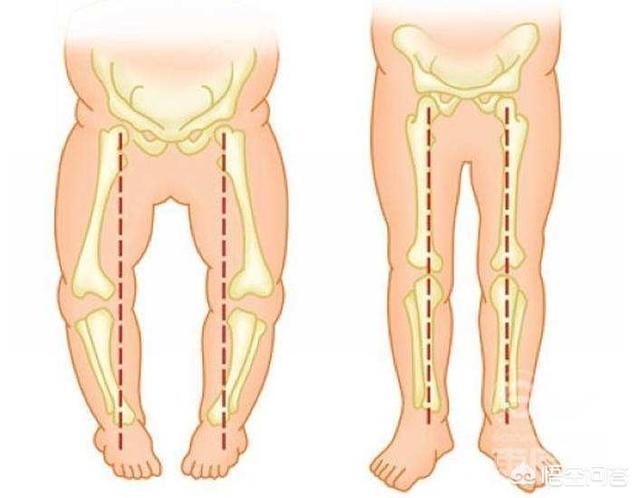 幼儿外八字:6个月宝宝脚有点内八怎么调整？