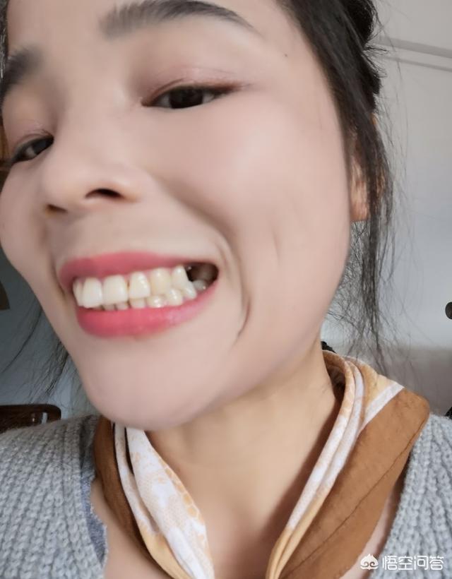 头条问答 - 二十岁左右满口假牙是什么体验?(13个回答)