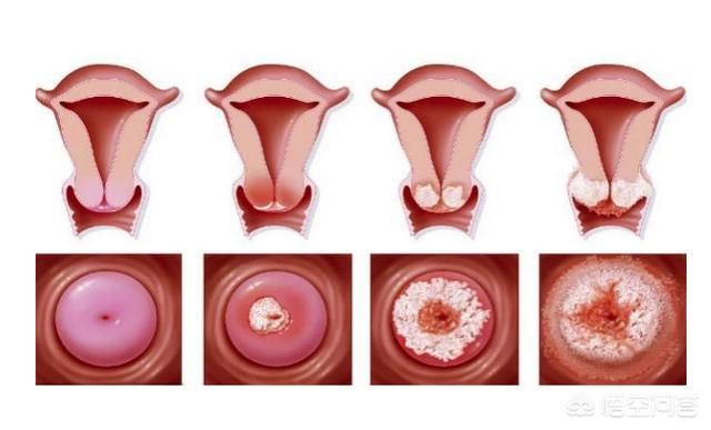 头条问答 - 宫颈口太小会影响受孕吗?(60个回答)