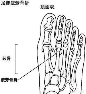 骨折和骨裂的症状:疲劳性骨裂有什么症状？长期一天走两万步会有吗？