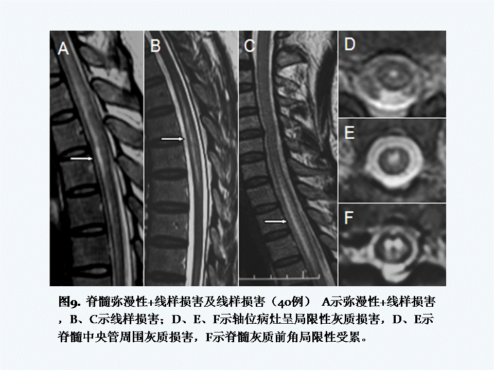 鸡脑脊髓炎病:鸡脑脊髓炎病毒传染人吗 脊髓炎是疾病还是坏习惯导致的？