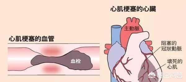 心梗常说,时间就是心肌,什么意思？