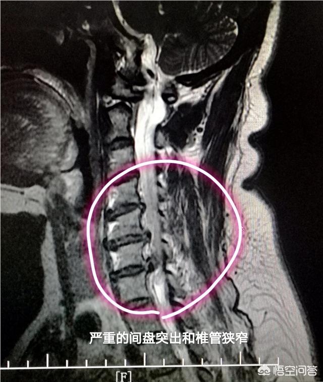 物理壮阳法图解，脂溢性脱发有方法吗求推荐