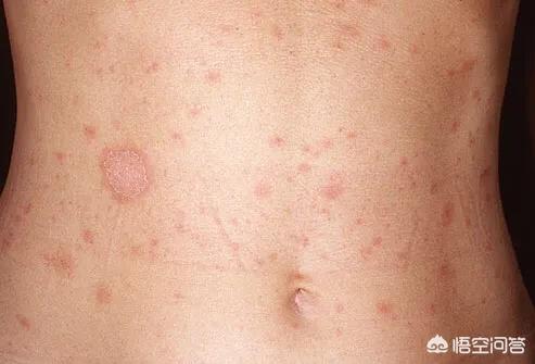 肝癌发生时,皮肤有什么异常变化?