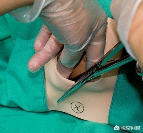肩难产:肩难产的七步处理方法 顺产需要在什么情况下侧切？