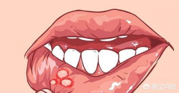 口腔溃疡为什么经常来找你，总是口腔溃疡，会是什么原因？