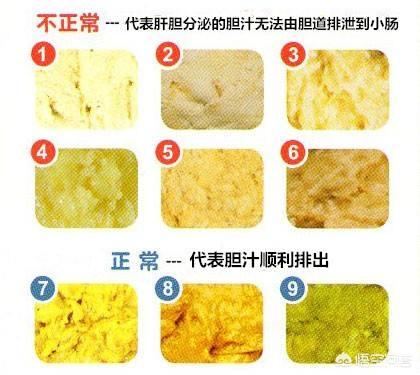 婴儿胆道阻塞的症状:如何从宝宝的便便来判断宝宝的消化情况？