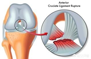 前交叉韧带断裂术后锻炼:前交叉韧带重建为啥整条腿肌肉都是紧张的？