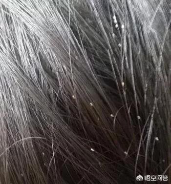 为什么长期不洗头就会生虱子?-百科网