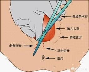 人剖腹产缝合几层图解图片