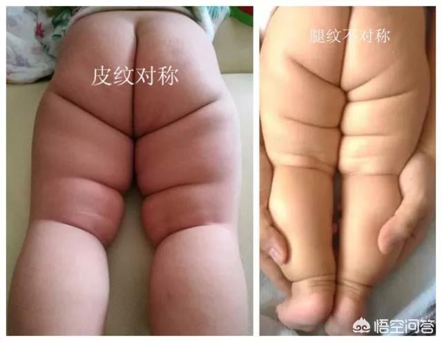 胯关节发育不良:宝宝下肢腿纹不对称就说明髋关节发育异常吗？