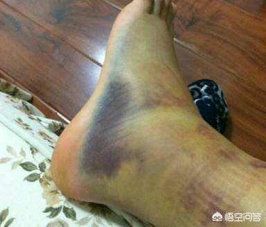 脚踝扭伤了怎么办:踝关节扭伤了，该如何处理？