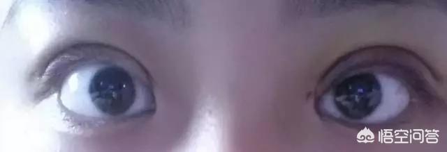 开眼角对比图:割双眼皮不开眼角是一种什么体验？