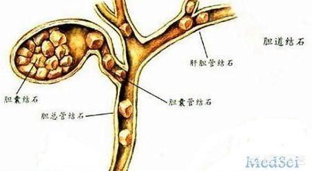 胆总管结石的症状是什么:大家对胆管结石了解多少？得了这个病治疗有什么好的建议吗？