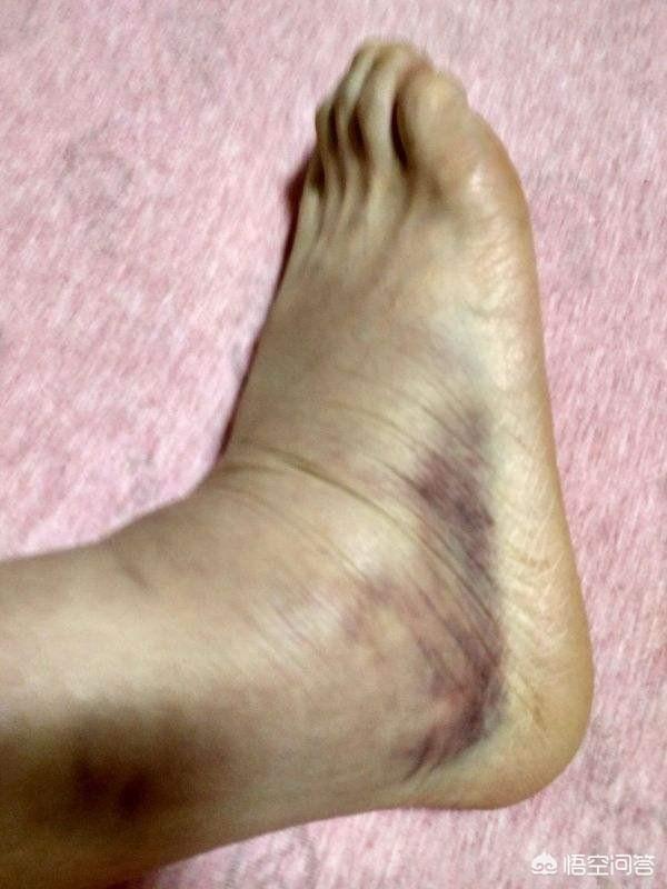 头条问答 - 打球崴脚怎么办?(15个回答)