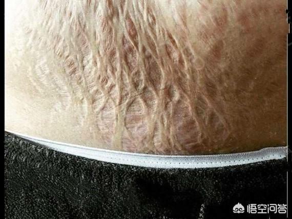 怀孕多久会长妊娠纹？为什么会长妊娠纹？插图15