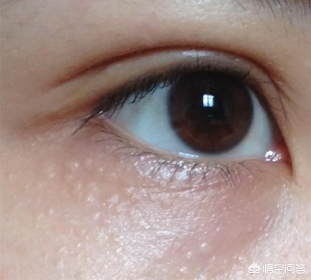 眼霜能去掉脂肪粒吗，脂肪粒如何消除可以自行消除吗