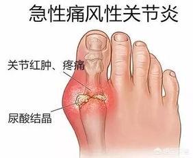 痛风患者在喝酒前，吃秋水仙碱能避免痛风发作吗？