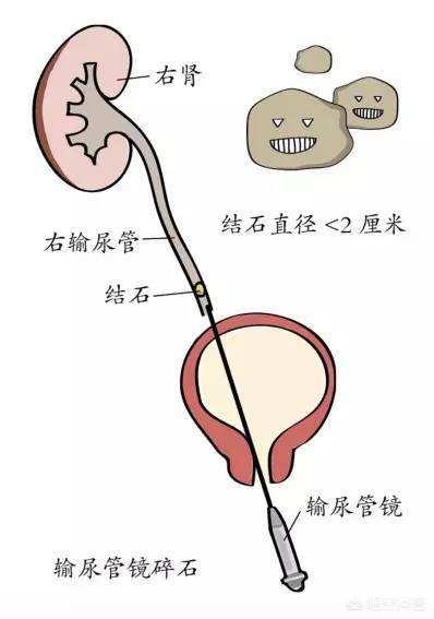 女性尿结石最佳治疗方法:1.6厘米的尿路结石怎么处理？