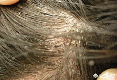 头条问答 - 头发上很多头皮屑,该怎样清理?(21个回答)