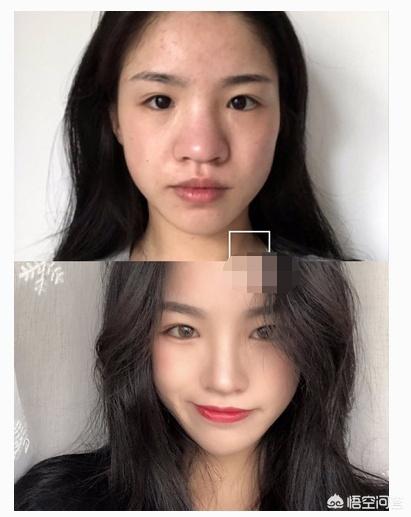 鼻翼宽怎么办(鼻子塌鼻翼大怎么办)