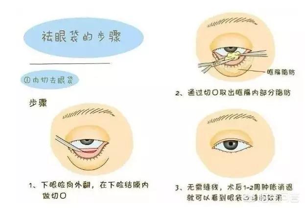 怎样去眼袋啊我是从小就有的那种